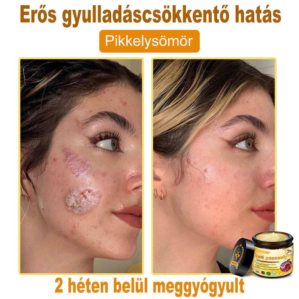 🐝PUROSA® Méhméreg Bőrmegújító Krém|Teljes körű megoldás a makacs bőrproblémák, például az öregedés, ekcéma, hegek és pikkelysömör ellen