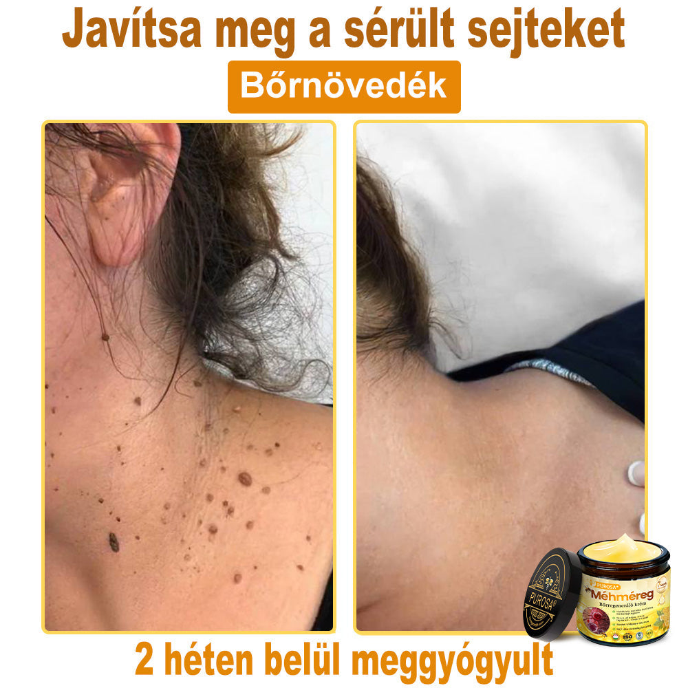 🐝PUROSA® Méhméreg Bőrmegújító Krém|Teljes körű megoldás a makacs bőrproblémák, például az öregedés, ekcéma, hegek és pikkelysömör ellen