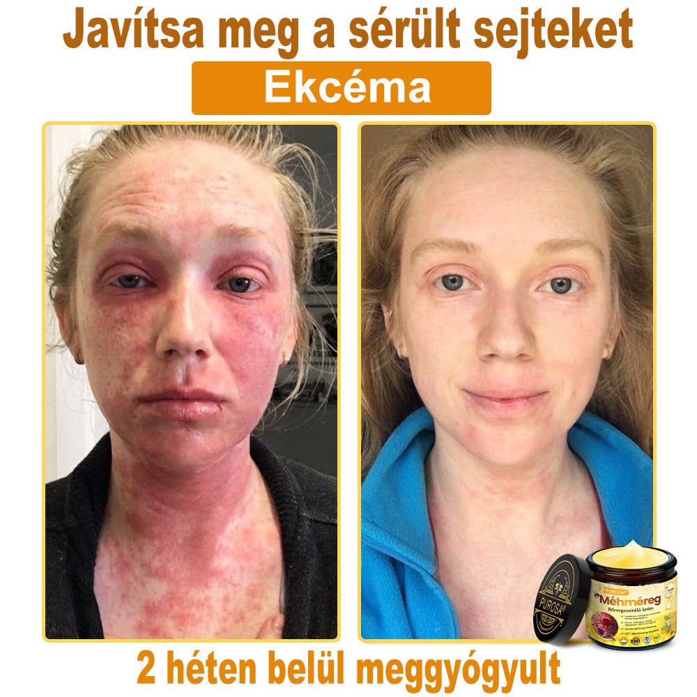 🐝PUROSA® Méhméreg Bőrmegújító Krém|Teljes körű megoldás a makacs bőrproblémák, például az öregedés, ekcéma, hegek és pikkelysömör ellen