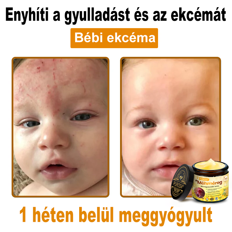 🐝PUROSA® Méhméreg Bőrmegújító Krém|Teljes körű megoldás a makacs bőrproblémák, például az öregedés, ekcéma, hegek és pikkelysömör ellen