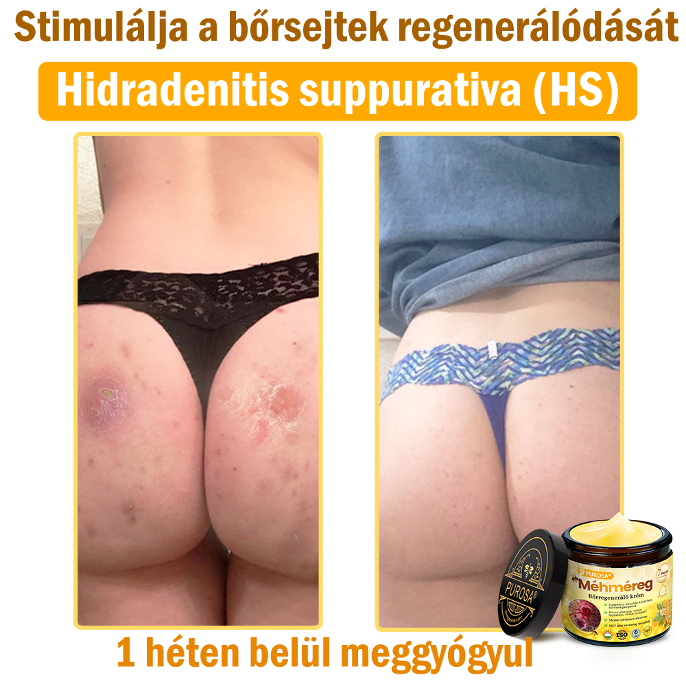 🐝PUROSA® Méhméreg Bőrmegújító Krém|Teljes körű megoldás a makacs bőrproblémák, például az öregedés, ekcéma, hegek és pikkelysömör ellen