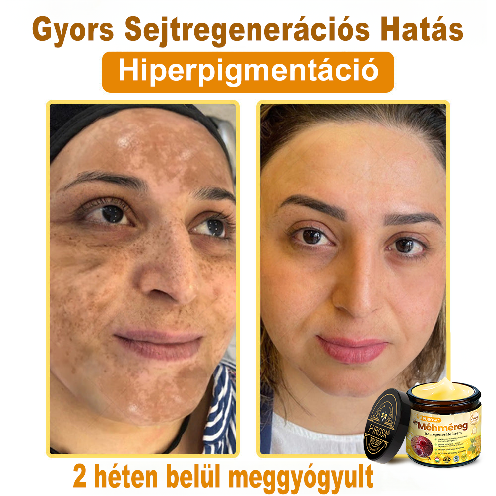 🐝PUROSA® Méhméreg Bőrmegújító Krém|Teljes körű megoldás a makacs bőrproblémák, például az öregedés, ekcéma, hegek és pikkelysömör ellen